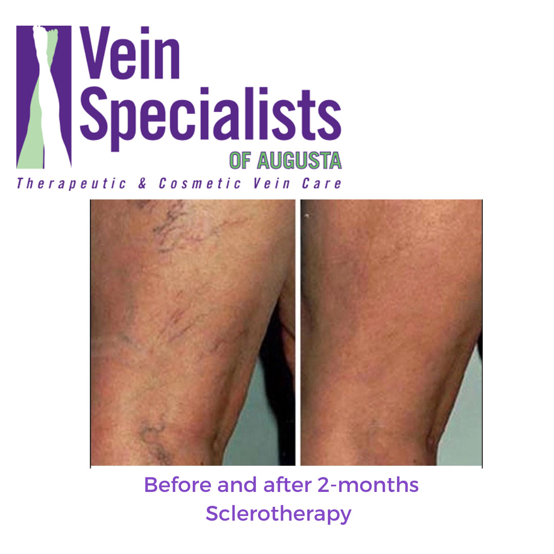 Before and after sclerotherapy at Vein Specialist of Augusta