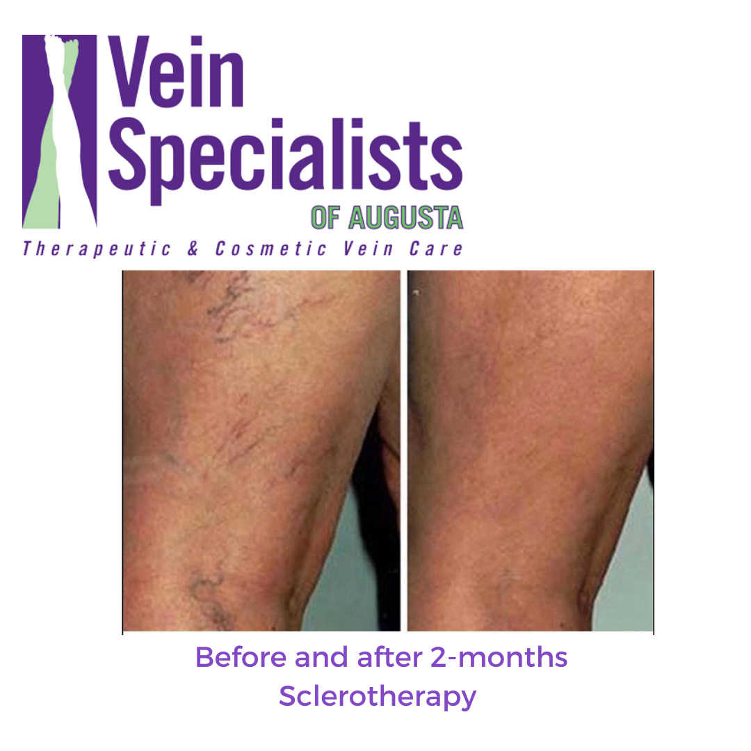 Can Stress Cause Spider Veins On Legs?