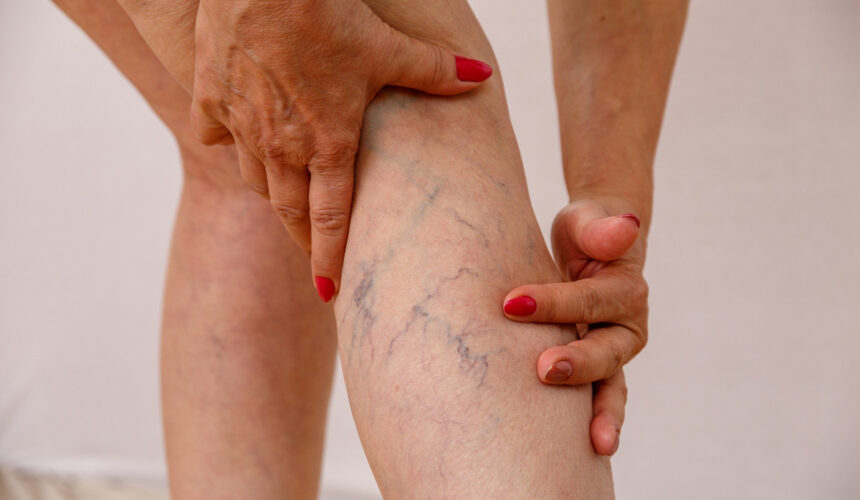 Advantages of Ambulatory Phlebectomy for Varicose Veins- Vein Specialist of Augusta