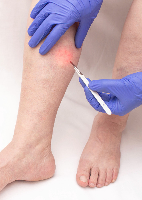 Ambulatory Phlebectomy Varicose Vein Treatment offered at Vein Specialist of Augusta