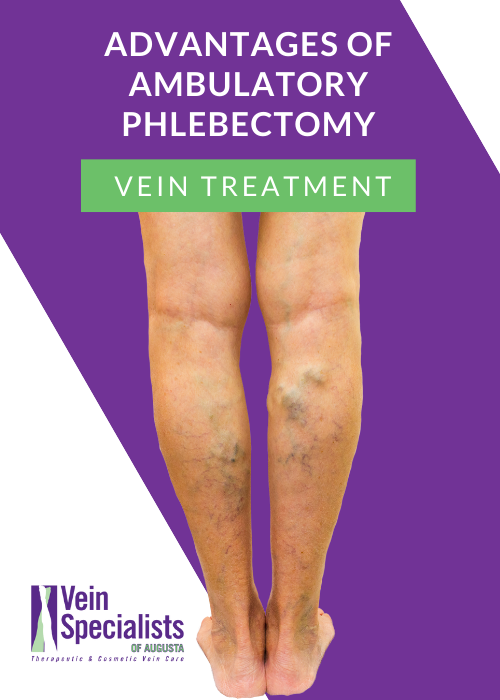 Advantages of Ambulatory Phlebectomy for Varicose Veins- Vein Specialist of Augusta