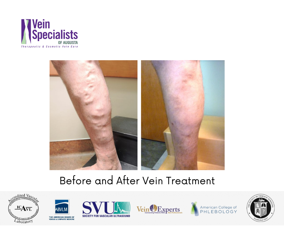 Before and After - Vein Specialists of Augusta