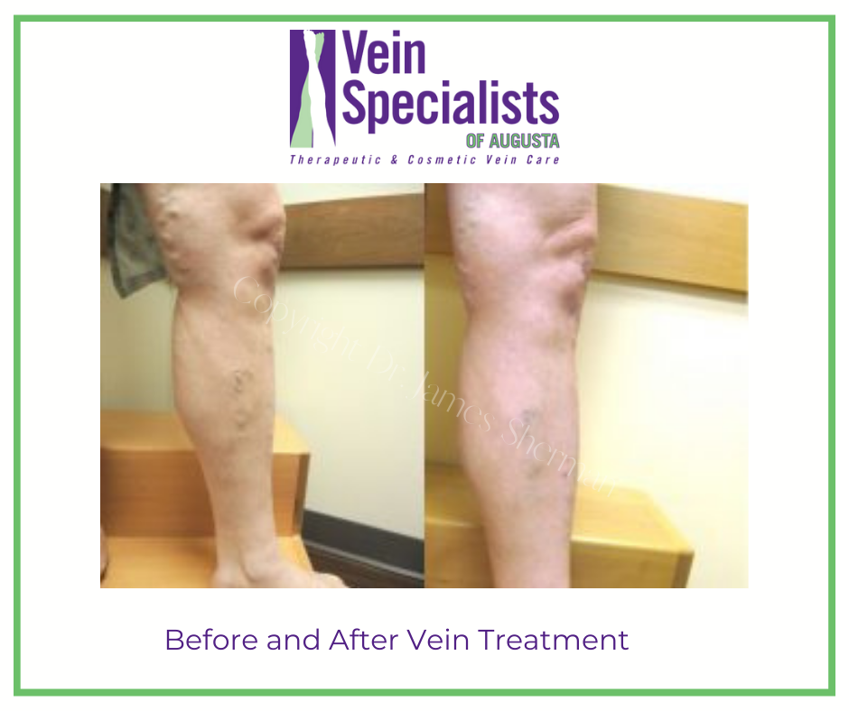 Before and After Laser Vein Treatment - Vein Specialists of Augusta