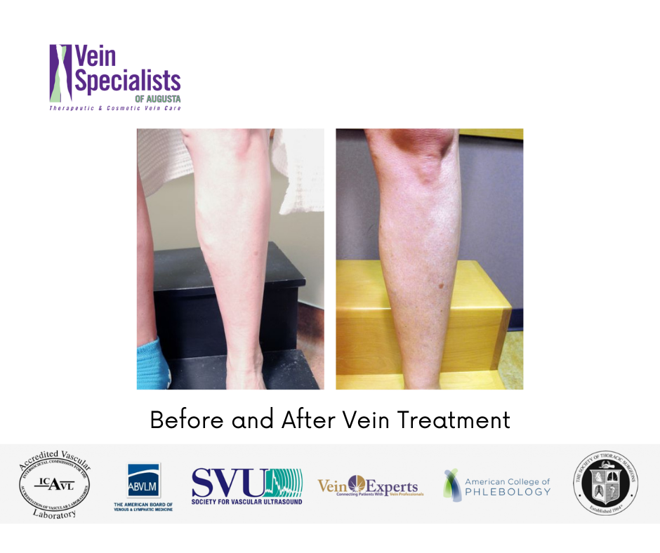 Before and After - Vein Specialists of Augusta