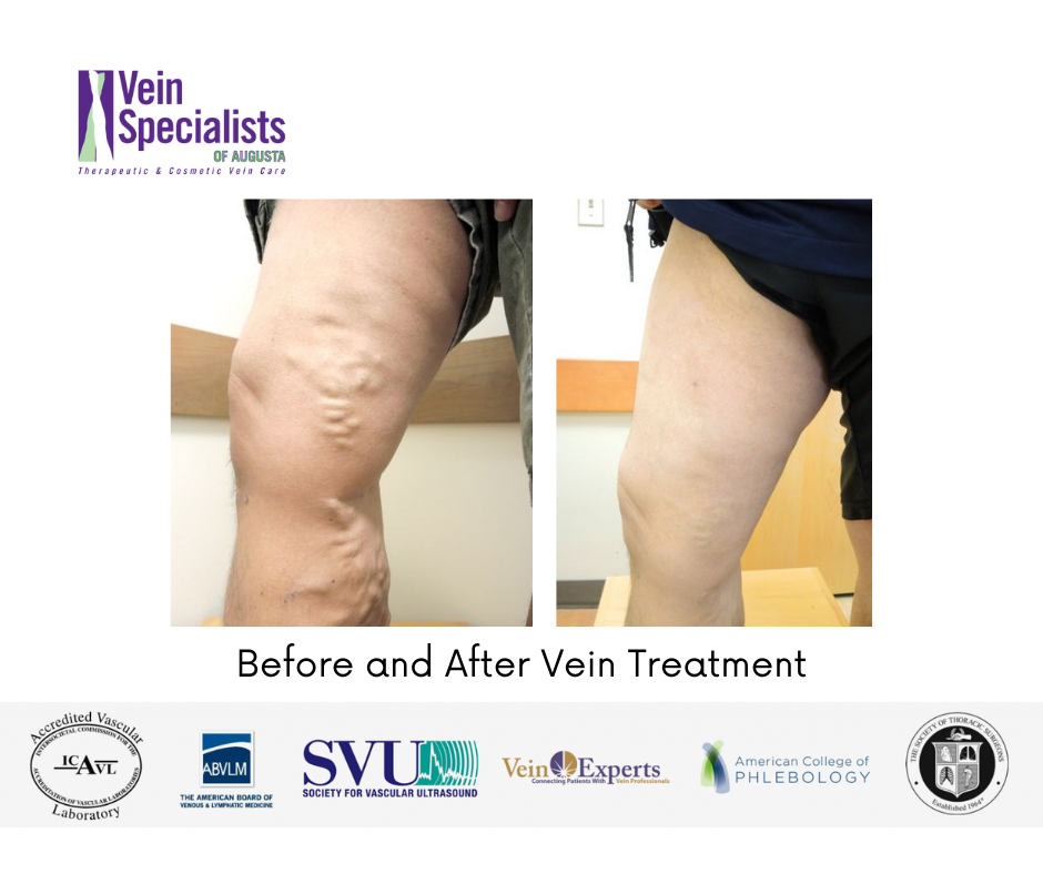 Before and After - Vein Specialists of Augusta