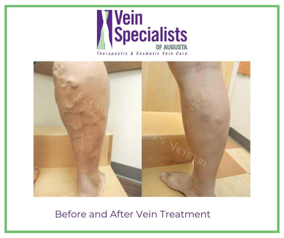 Before and After Laser Vein Treatment - Vein Specialists of Augusta