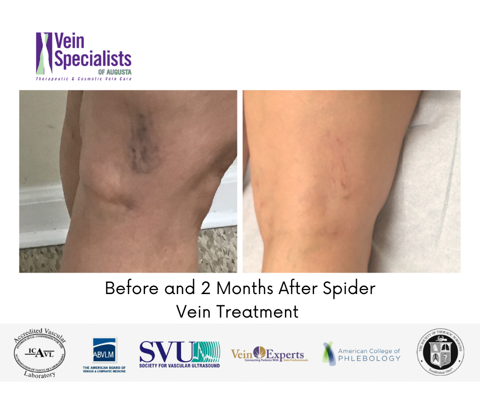 Before and after 2-months of receiving Spider vein Treatment -Vein Specialist of Augusta