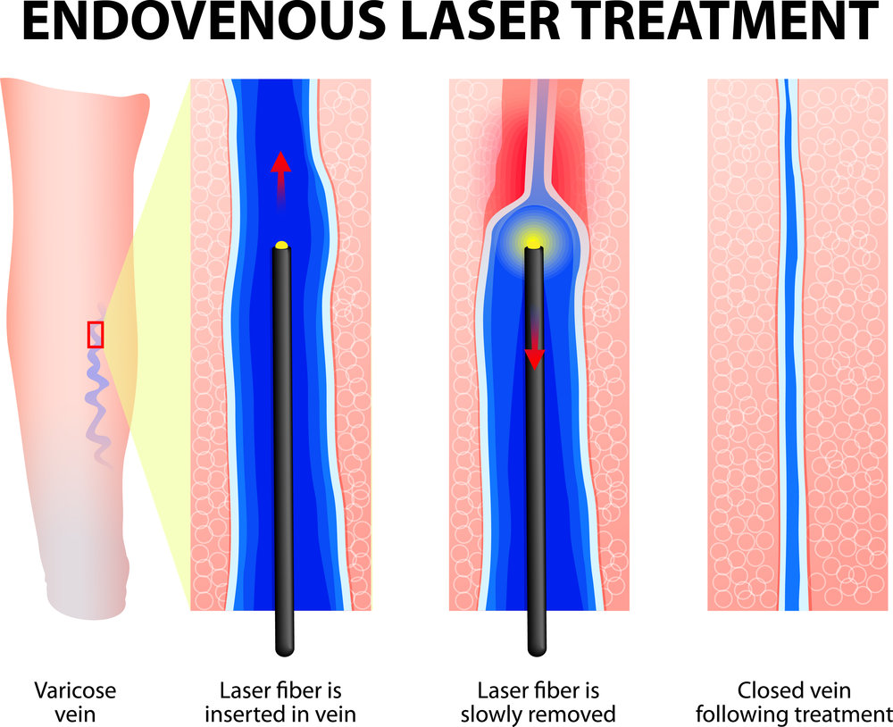 Endovenous Treatment available at Vein Specialist of Augusta in Georgia