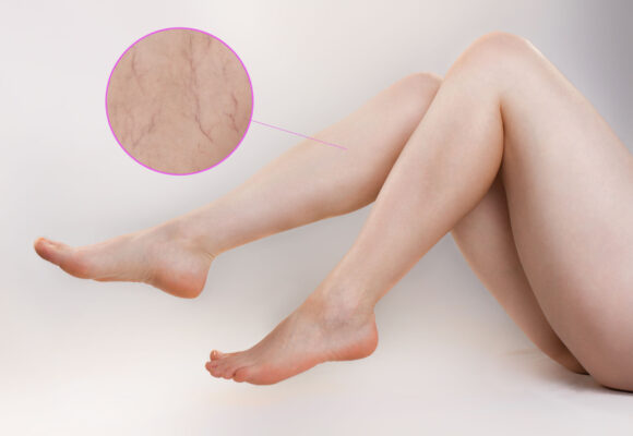 Healthy Legs For Life - Vein Treatment at Vein Specialist of Augusta