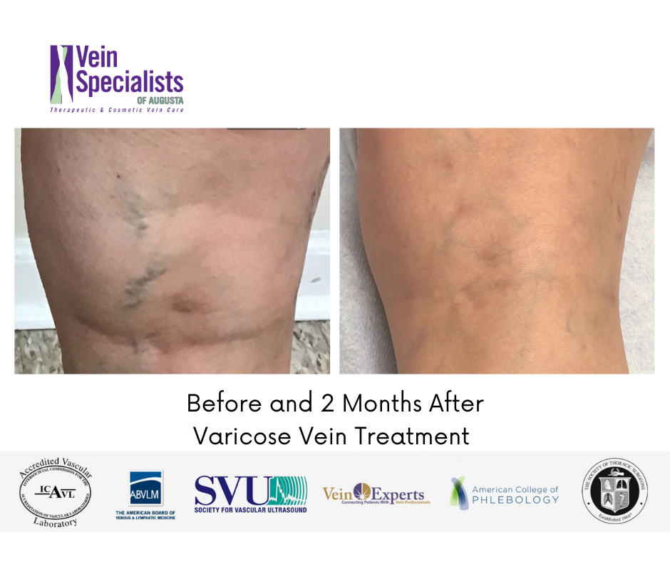 Before and after 2-months of receiving Varicose vein Procedure -Vein Specialist of Augusta