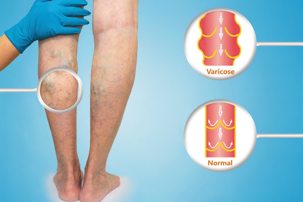 leg with Spider Vein and Varicose Vein - Vein Treatment consultation at our Vein Clinic in Augusta, Georgia