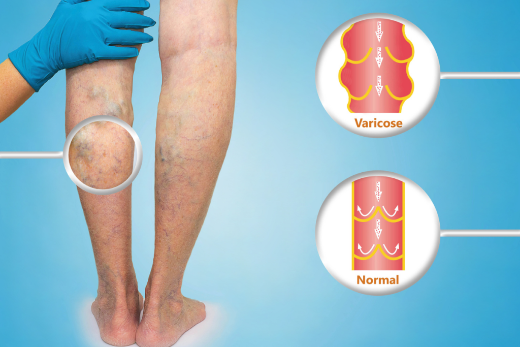 Can Stress Cause Spider Veins On Legs?