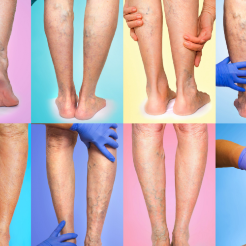 Multiple leg and vein issues- vein treatment at Vein Specialist of Augusta