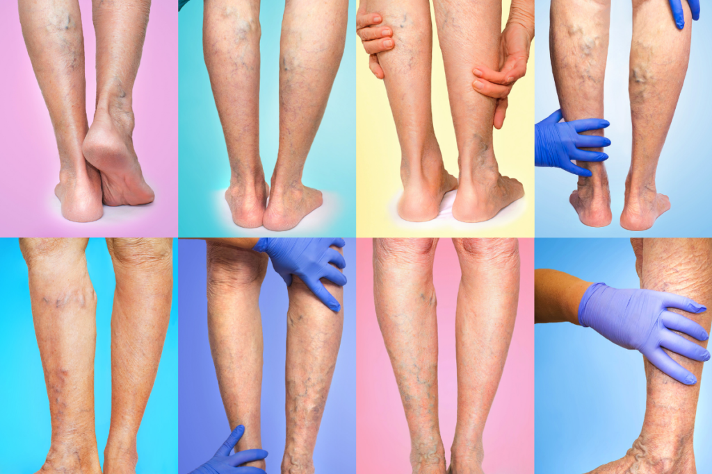 What Are Spider Veins - Spider Vein Treatment