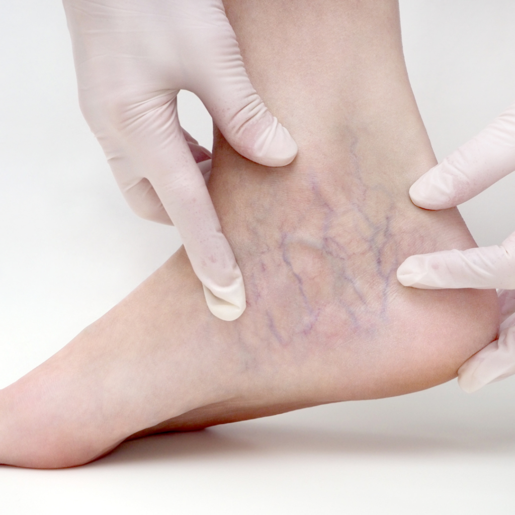 Vein Treatments available with Dr. James Sherman in Augusta Georgia