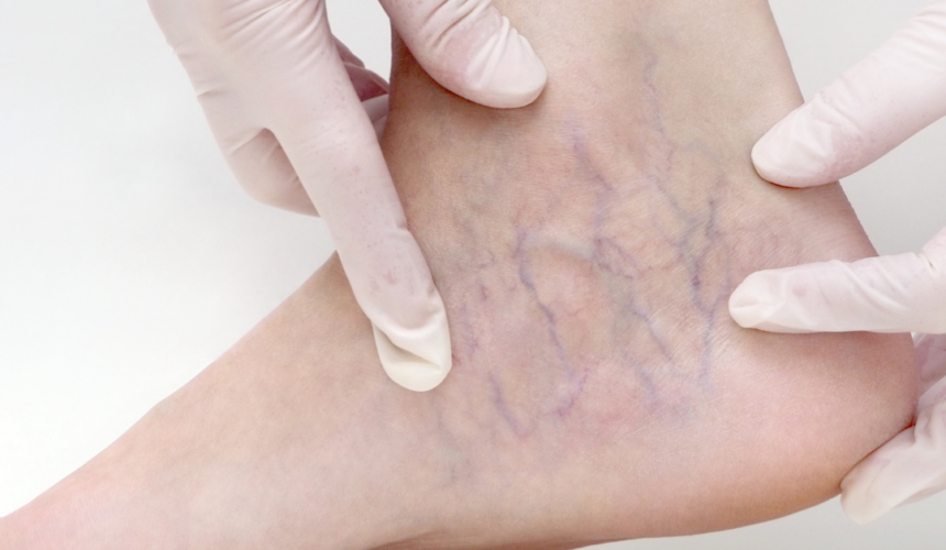 Vein Treatments available with Dr. James Sherman in Augusta Georgia