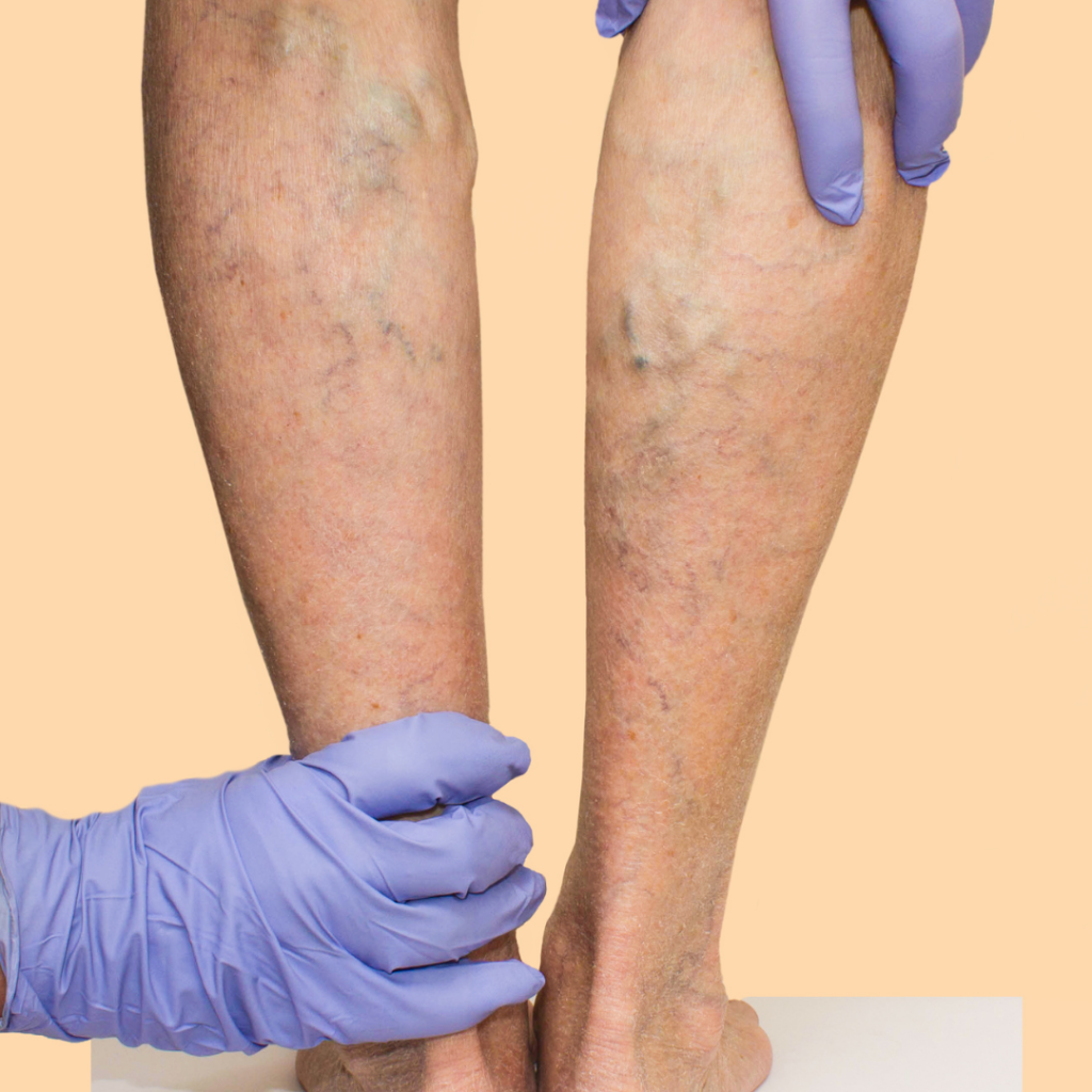 gloved hands touching swollen legs - Varicose Veins on Legs- treat vein issues at Vein Specialist of Augusta