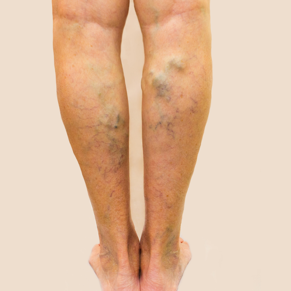 Legs with Varicose Veins - a treatable condition at Vein Specialist of Augusta
