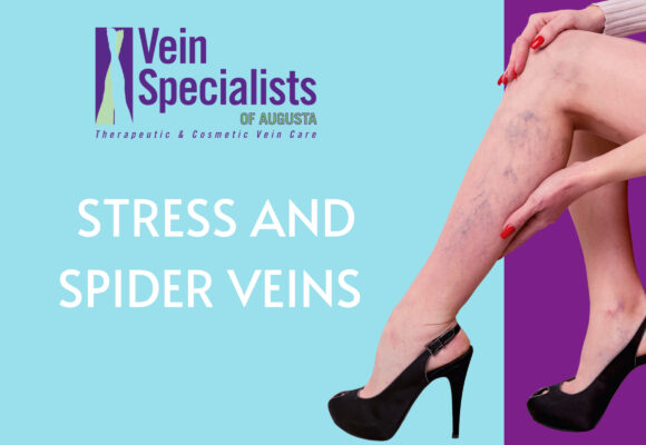 Stress and Spider Veins- Vein Specialists of Augusta