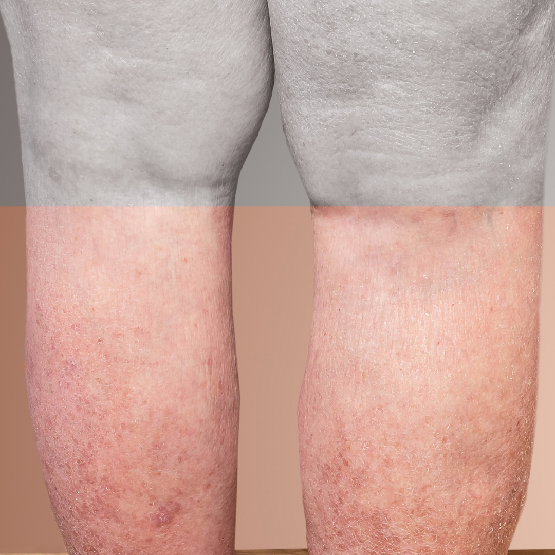 Legs with venous insufficiency- treatment for venous insufficiency at Vein Clinic Augusta in Georgia