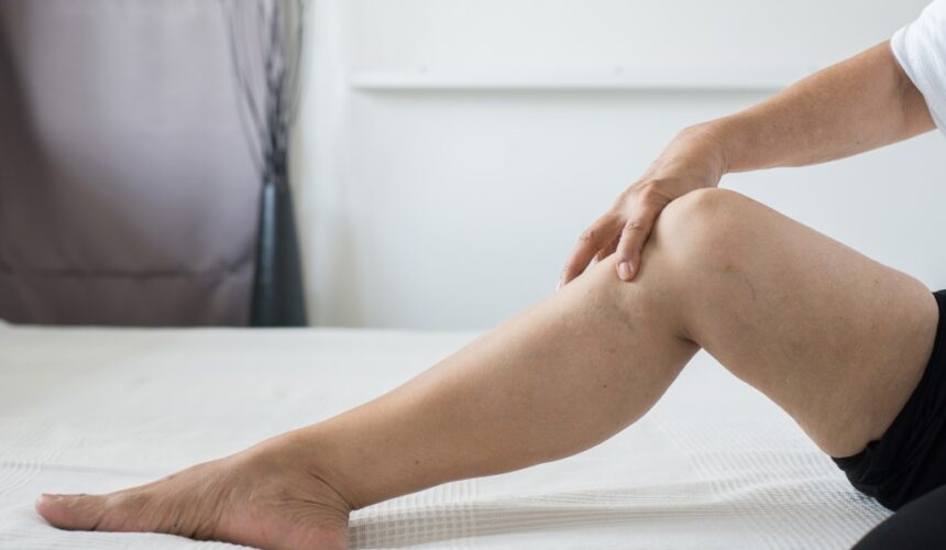 Spider Veins on Woman's leg- vein treatment at Vein Specialist of Augusta