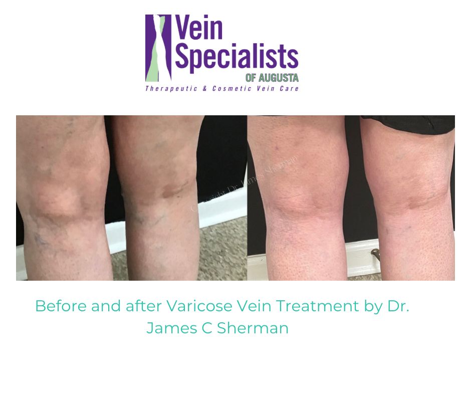Before and After Varicose vein Treatment by Dr James C Sherman