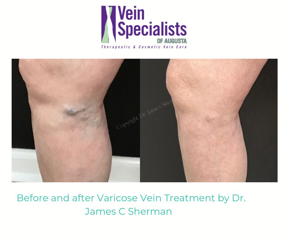 Before and After Varicose vein Treatment by Dr James C Sherman at Veins Specialists of Augusta