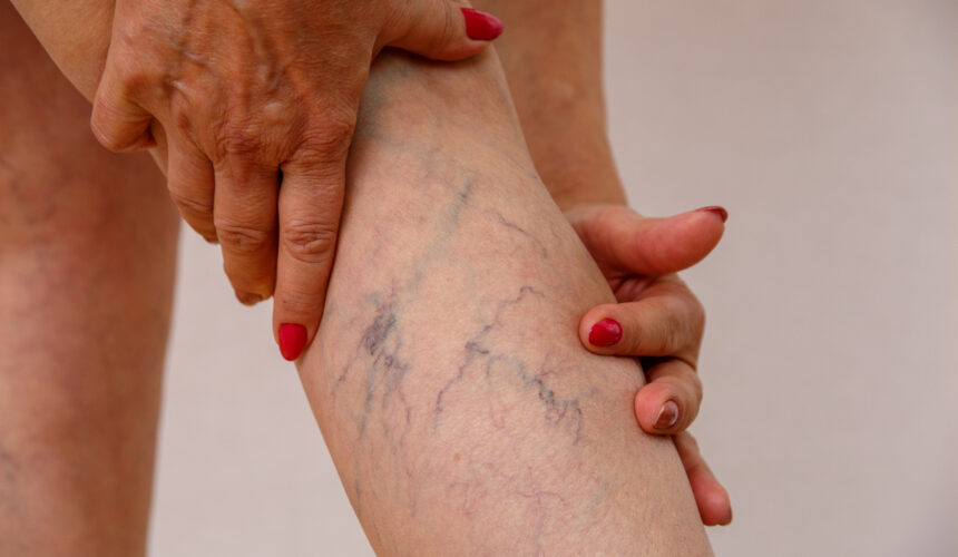 Advanced Vein Disease treatment by Dr James Sherman at veins clinic Augusta