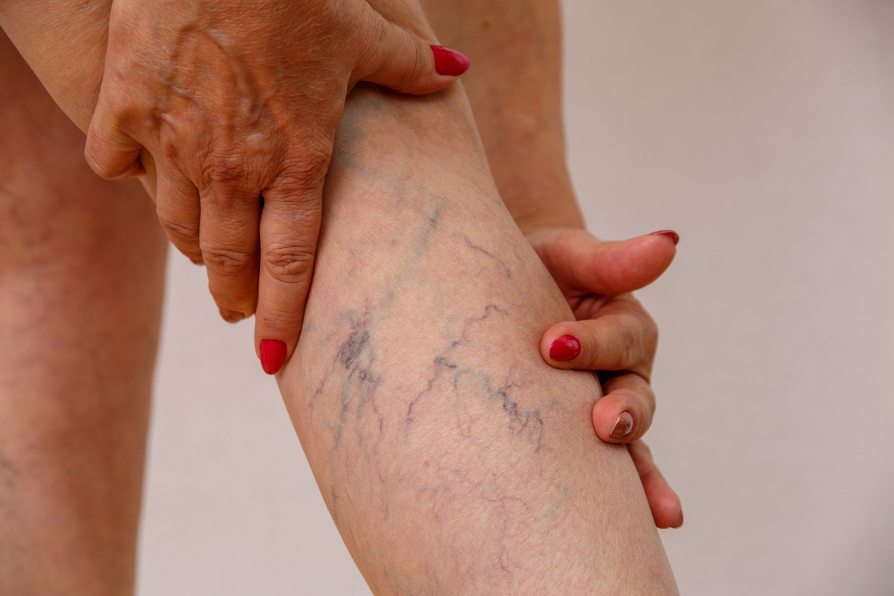 Advanced Vein Disease treatment by Dr James Sherman at veins clinic Augusta