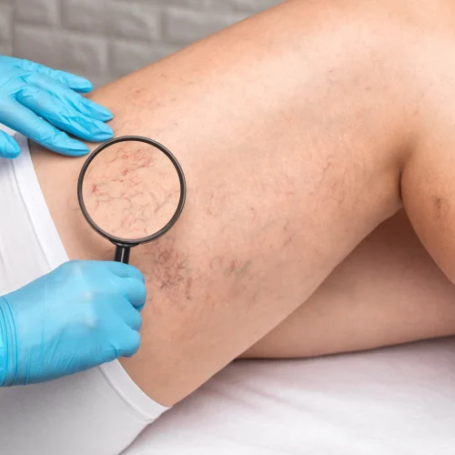 Comprehensive Guide to Vein Care at Vein Specialists of Augusta